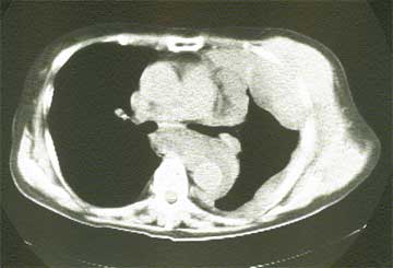 悪性胸膜中皮腫CT像