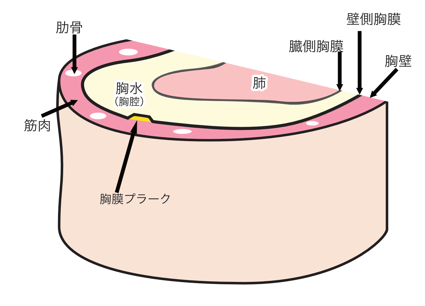 胸膜プラーク（胸膜肥厚斑） 斑（まだら） 胸部CT