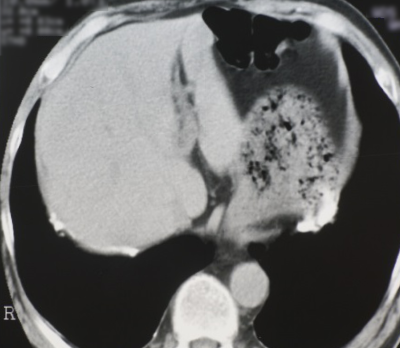 胸部X線写真で見逃され、峡部CTで見つかる胸膜プラーク（胸膜肥厚斑）